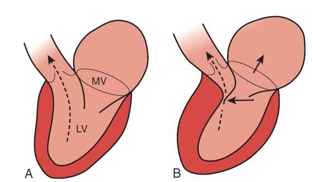 pimobendan-p3-venturi-effect-2